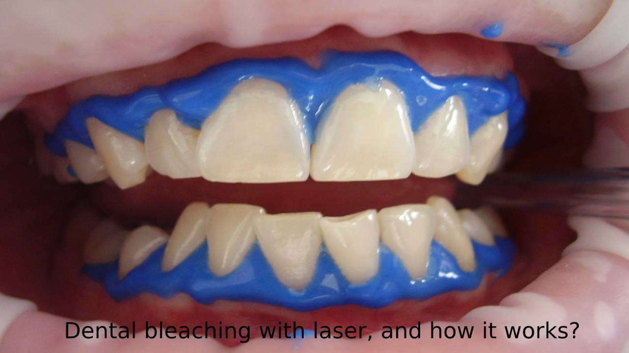 Dental bleaching with laser, and how it works?